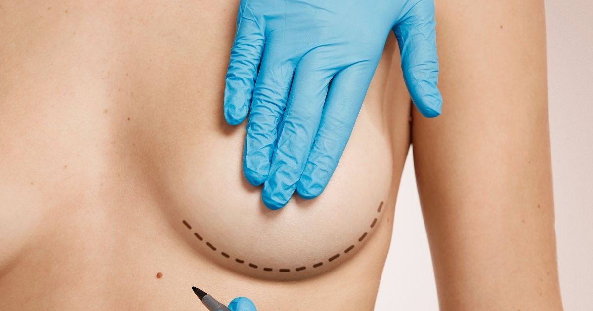 Qué es una mastopexia el doctor lurduy explica que es
