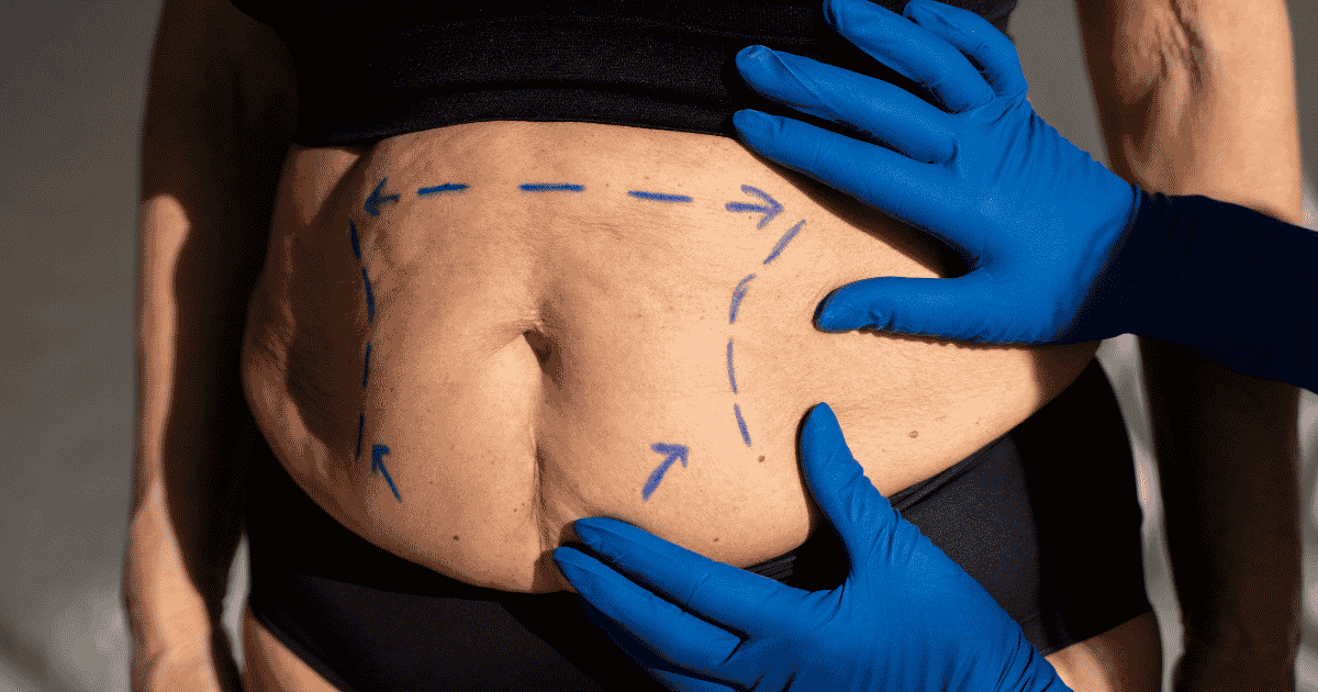 La abdominoplastia 360, también conocida como lipectomía en cinturón o abdominoplastia circunferencial, busca tratar ese exceso de tejido alrededor del torso.