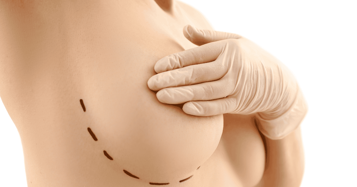 implantes de senos tamaño, aumento mamario cc, 350 cc o 400 cc, tamaño de implantes, prótesis mamarias, cirugía de aumento de senos.